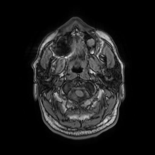 File:Cerebellar hemangioblastoma (Radiopaedia 88055-104622 Axial T1 5).jpg