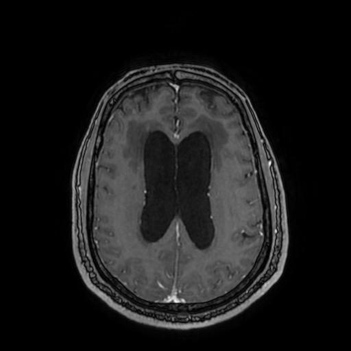 Cerebellar hemangioblastoma (Radiopaedia 88055-104622 Axial T1 C+ 117).jpg