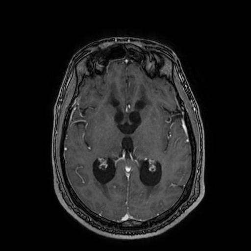 Cerebellar hemangioblastoma (Radiopaedia 88055-104622 Axial T1 C+ 96).jpg