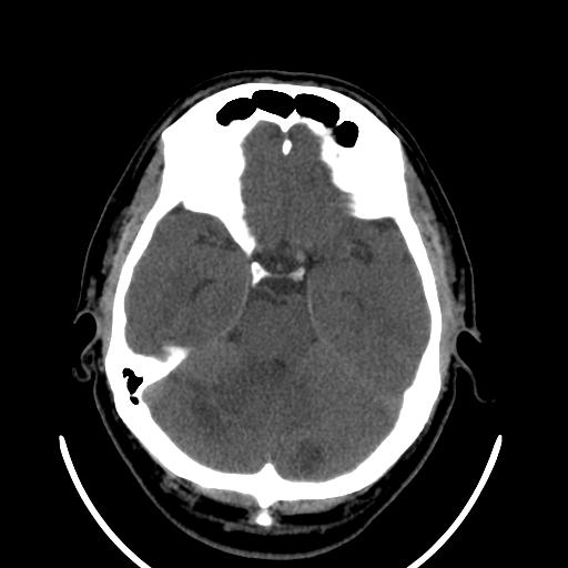 File:Cerebellar infarction (Radiopaedia 16625-16327 Axial non-contrast 14).jpg