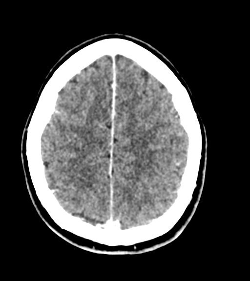 Cerebellar metastases - colorectal adenocarcinoma (Radiopaedia 40947-43652 Axial C+ 50).png