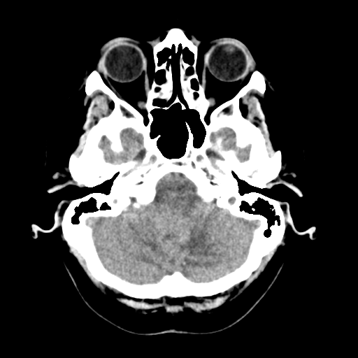 Cerebellar metastasis (Radiopaedia 54578-60812 Axial non-contrast 10).png