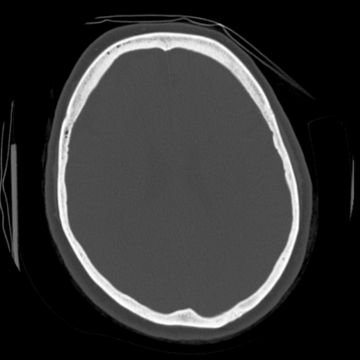Cerebellar metastasis (cystic appearance) (Radiopaedia 41395-44258 Axial bone window 44).png