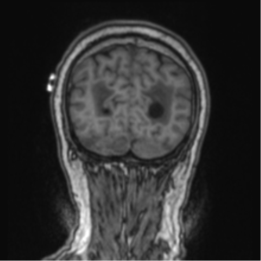 Cerebellar metastasis from lung adenocarcinoma (Radiopaedia 86690-102829 Coronal T1 17).png