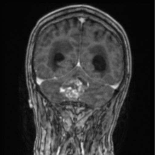 Cerebellar metastasis from lung adenocarcinoma (Radiopaedia 86690-102829 Coronal T1 C+ 28).png
