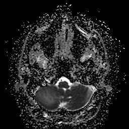 File:Cerebellar metastasis of pulmonary adenocarcinoma, cavernous venous malformation, and developmental venous anomaly (Radiopaedia 85827-101661 Axial ADC 7).jpg