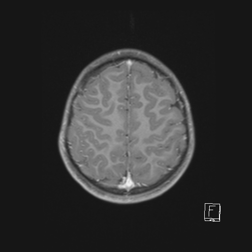 Cerebellar stroke (Radiopaedia 32202-33150 Axial T1 C+ 56).png