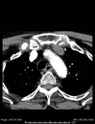 File:Cerebellar strokes due to intracranial giant cell arteritis (Radiopaedia 68799-78510 CT angiogram 153).jpg