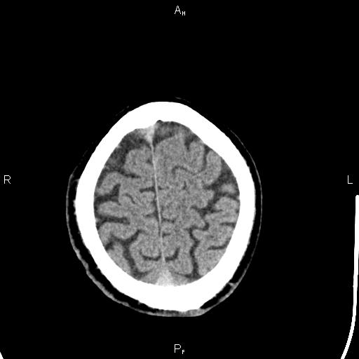 Cerebellopontine angle arachnoid cyst (Radiopaedia 85149-100704 Axial With contrast 45).jpg
