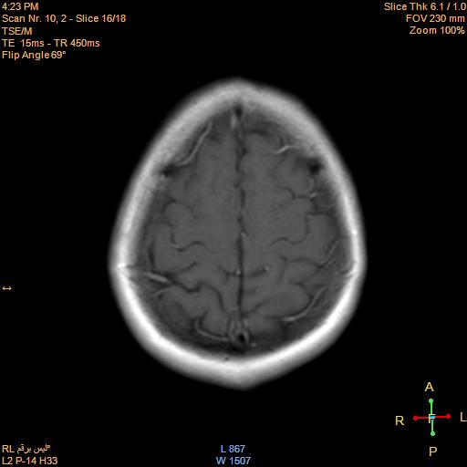 File:Cerebellopontine angle meningioma (Radiopaedia 22488-22525 Axial T1 C+ 15).jpg
