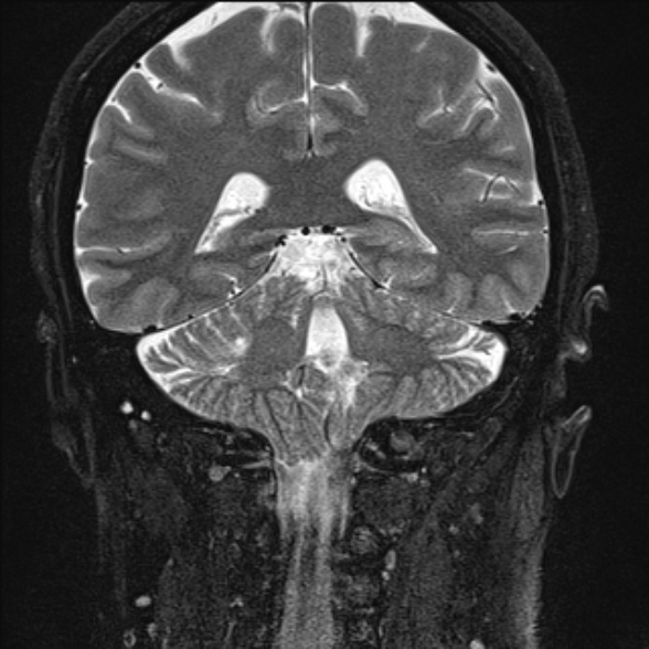 File:Cerebellopontine angle meningioma (Radiopaedia 53561-59591 Coronal T2 19).jpg