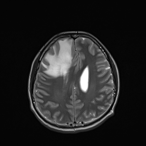Cerebral abscess (Radiopaedia 24212-24478 Axial T2 42).jpg