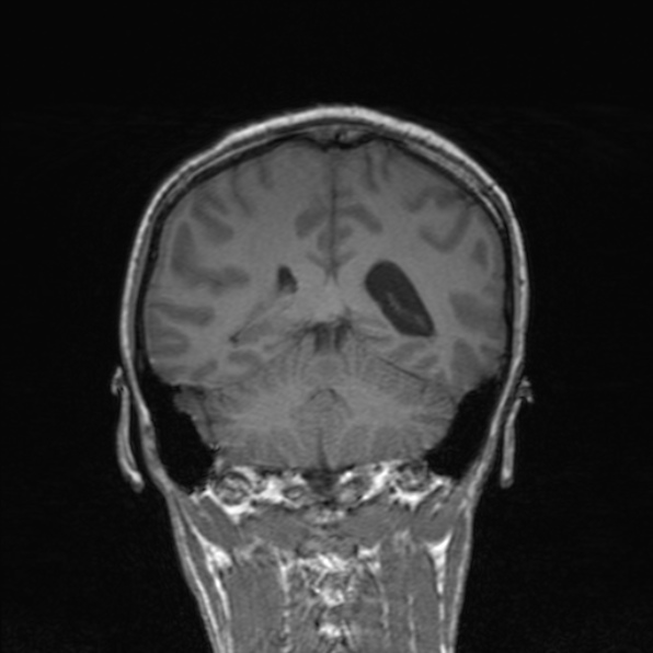 Cerebral abscess (Radiopaedia 24212-24478 Coronal T1 140).jpg