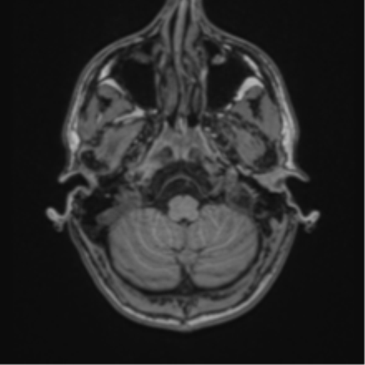 File:Cerebral abscess (Radiopaedia 60342-68009 Axial T1 4).png
