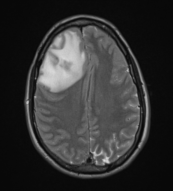 File:Cerebral abscess (Radiopaedia 60342-68009 Axial T2 25).png
