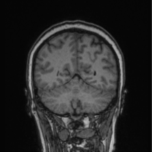 File:Cerebral abscess from pulmonary arteriovenous malformation (Radiopaedia 86275-102291 Coronal T1 27).png