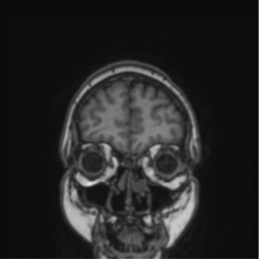 File:Cerebral abscess from pulmonary arteriovenous malformation (Radiopaedia 86275-102291 Coronal T1 76).png