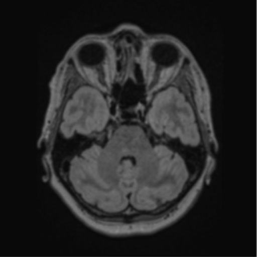 Cerebral abscess from pulmonary arteriovenous malformation (Radiopaedia 86275-102291 J 24).png