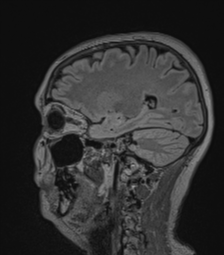 Cerebral abscess from pulmonary arteriovenous malformation (Radiopaedia 86275-102291 Sagittal FLAIR 26).png