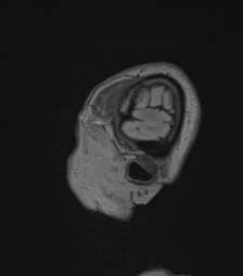 Cerebral abscess from pulmonary arteriovenous malformation (Radiopaedia 86275-102291 Sagittal FLAIR 69).png