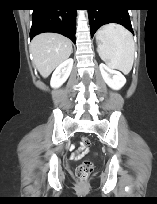 Cerebral abscess from pulmonary arteriovenous malformation (Radiopaedia 86275-102292 D 37).png