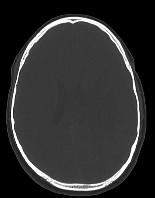 Cerebral abscesses (Radiopaedia 70458-80568 Axial bone window 38).jpg