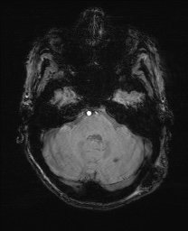 File:Cerebral amyloid angiopathy-related inflammation (Radiopaedia 74836-85849 Axial SWI 18).jpg