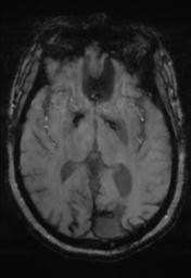 File:Cerebral amyloid angiopathy (Radiopaedia 29129-29518 Axial SWI Magnitude 17).jpg