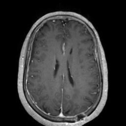 Cerebral amyloid angiopathy (Radiopaedia 29129-29518 Axial T1 C+ 95).jpg