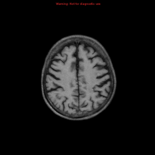 File:Cerebral and orbital tuberculomas (Radiopaedia 13308-13311 Axial T1 16).jpg