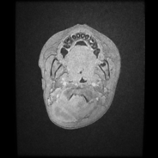 Cerebral and spinal tuberculosis (Radiopaedia 90489-107837 Axial T1 C+ 5).jpg