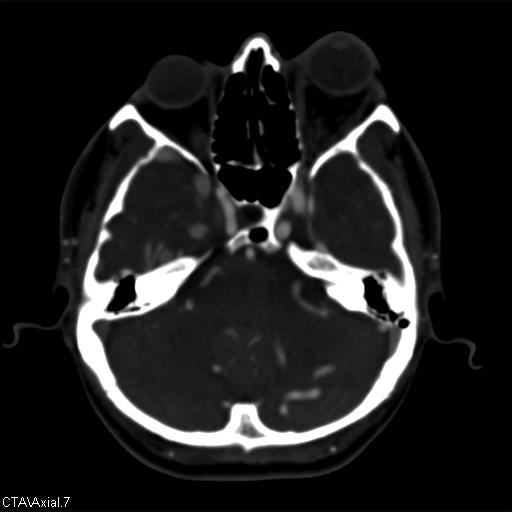 Cerebral arteriovenous malformation (Radiopaedia 28518-28759 B 7).jpg