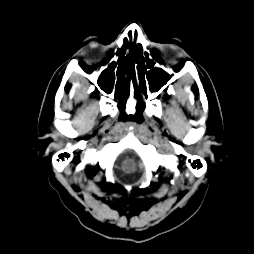 File:Cerebral arteriovenous malformation (Radiopaedia 39259-41505 Brain Ax 5mm 2).png