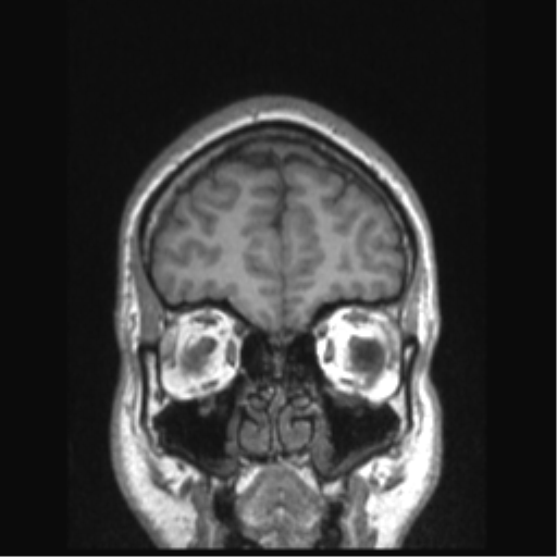 Cerebral arteriovenous malformation (Radiopaedia 39259-41506 Coronal T1 78).png