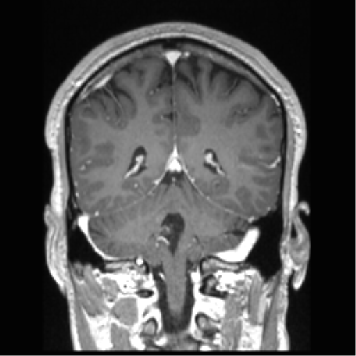 Cerebral arteriovenous malformation (Radiopaedia 39259-41506 Coronal T1 C+ 34).png