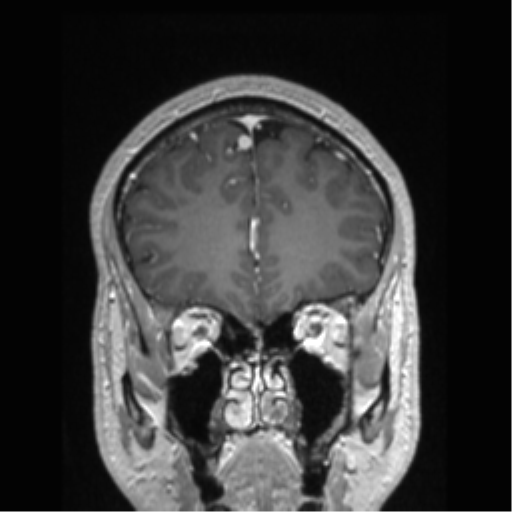 Cerebral arteriovenous malformation (Radiopaedia 39259-41506 Coronal T1 C+ 72).png