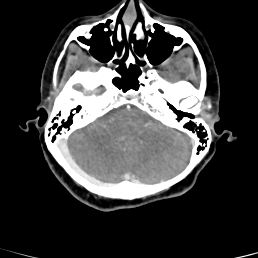 File:Cerebral arteriovenous malformation (Radiopaedia 73830-84645 B 77).jpg