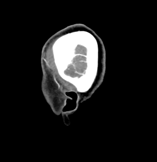 Cerebral arteriovenous malformation (Radiopaedia 73830-84645 D 5).jpg