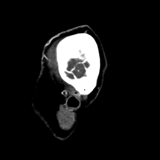 Cerebral arteriovenous malformation (Radiopaedia 73830-84645 Sagittal C+ delayed 87).jpg