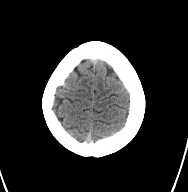 File:Cerebral arteriovenous malformation (Radiopaedia 74411-85744 Axial non-contrast 31).jpg