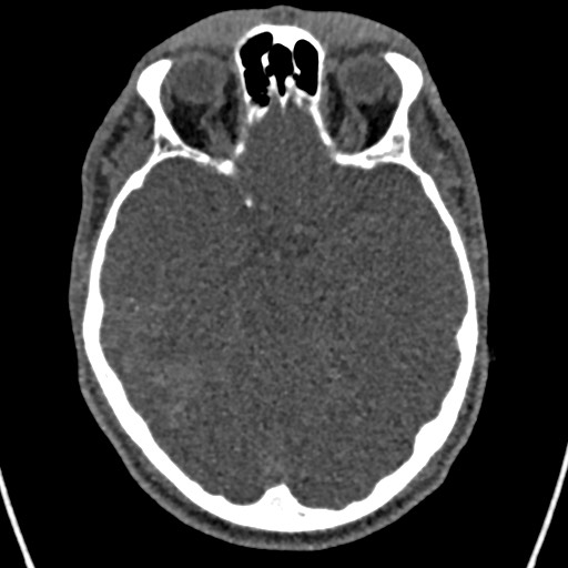 Cerebral arteriovenous malformation (Radiopaedia 78188-90746 Axial non-contrast 66).jpg