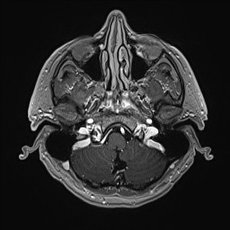 Cerebral arteriovenous malformation (Radiopaedia 84015-99245 Axial T1 C+ 32).jpg