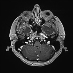 Cerebral arteriovenous malformation (Radiopaedia 84015-99245 Axial T1 C+ 38).jpg