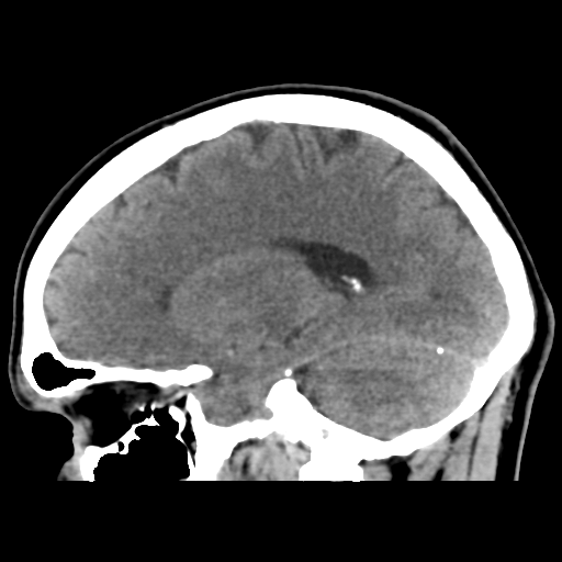 Cerebral arteriovenous malformation (Spetzler-Martin grade 2) (Radiopaedia 41262-44076 A 39).png