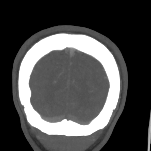 File:Cerebral arteriovenous malformation (Spetzler-Martin grade 2) (Radiopaedia 41262-44076 F 59).png