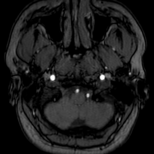 Cerebral arteriovenous malformation at posterior body of corpus callosum (Radiopaedia 74111-84925 Axial MRA 9).jpg