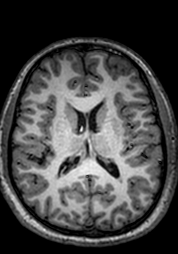 File:Cerebral arteriovenous malformation at posterior body of corpus callosum (Radiopaedia 74111-84925 Axial T1 122).jpg