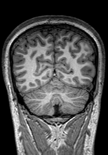 Cerebral arteriovenous malformation at posterior body of corpus callosum (Radiopaedia 74111-84925 Coronal T1 275).jpg