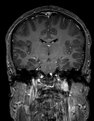 Cerebral arteriovenous malformation at posterior body of corpus callosum (Radiopaedia 74111-84925 K 192).jpg