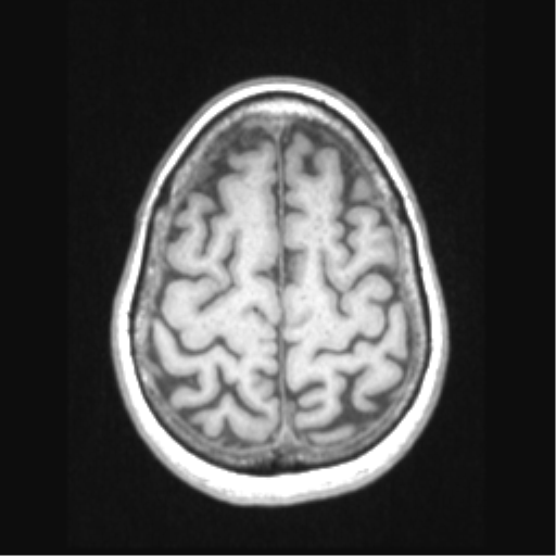 Cerebral arteriovenous malformation with hemorrhage (Radiopaedia 34422-35737 Axial T1 62).png